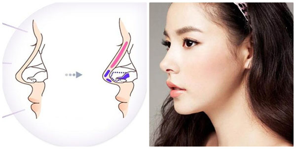 Dụng cụ nâng mũi Nose up
