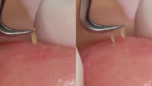 Nhíp nhổ mụn đầu đen Vetus